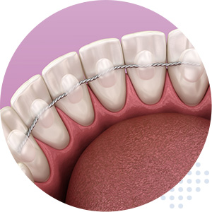 inbrace lingual braces