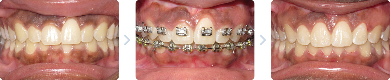 soft-tissue-laser-orthodontic-treatment-before-after