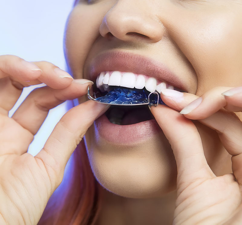 girl-placing-retainer-on-her-teeth