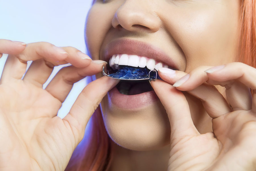 girl-placing-retainer-on-her-teeth