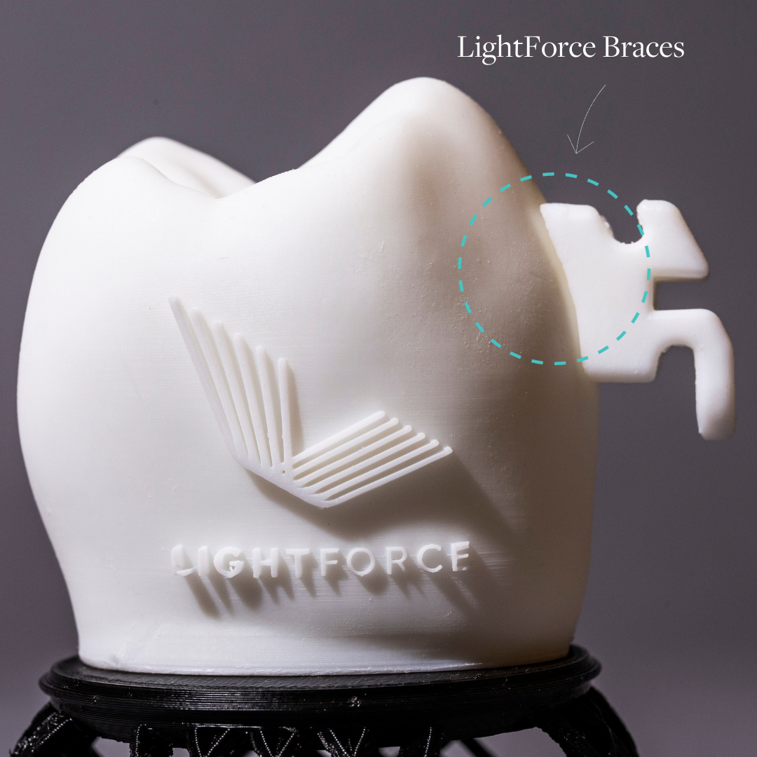 6 Ways LightForce Braces Are Redefining the Patient Experience
